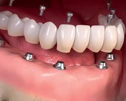 Full Mouth Dental Implant