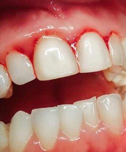 Periodontitis- The Disease That Goes Untreated and Unnoticed