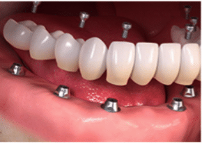 Full arch/mouth dental implants-1