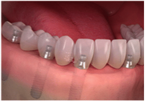 Full arch/mouth dental implants-2