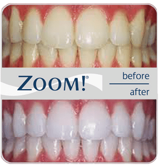 Zoom your way to white teeth.