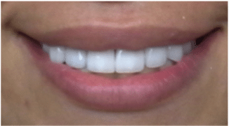 Chipped Teeth restoration