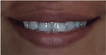 Patient with Chipped Tooth