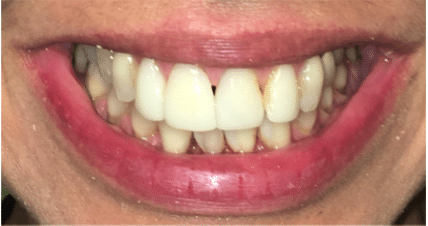 before with yellow uneven teeth