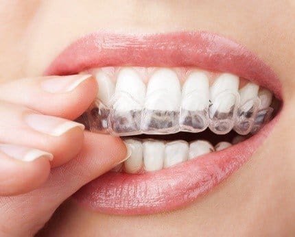 Yes… You Need To Wear Your Retainer After Braces!