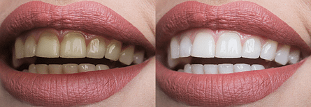 Teeth whitening will make you more confident when you smile.