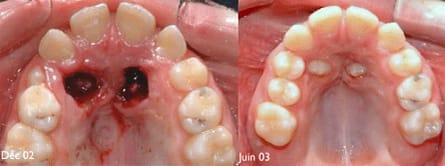 The Naked Truth: Exposure of Unerupted Teeth