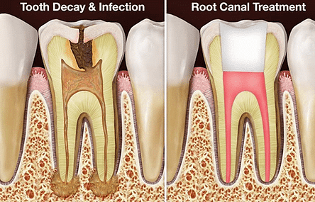 Root canals can save your teeth and your life.
