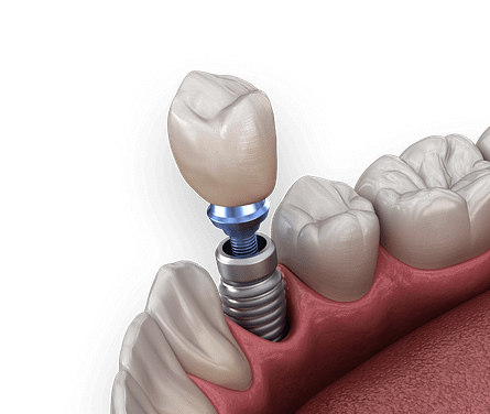 The truth about dental implants and how much they REALLY cost!