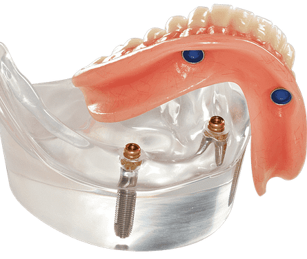 Implant Overdenture: “It’s a SNAP”!