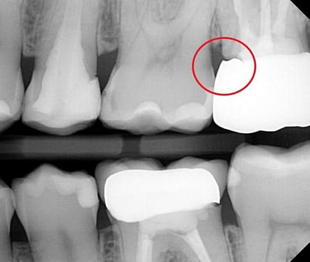 Is your dentist making sure your crown is fully seated? The truth about open margins.