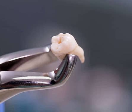 Had your Wisdom Tooth removed? We will tell you how to prevent Dry Socket.