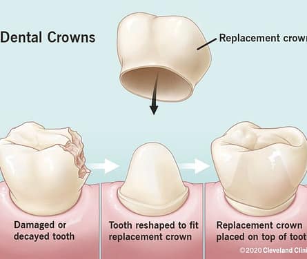 Why Crowns are Sometimes Needed Instead of a Filling.