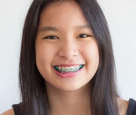 Braces Crash Course- Everything You Need To Know: