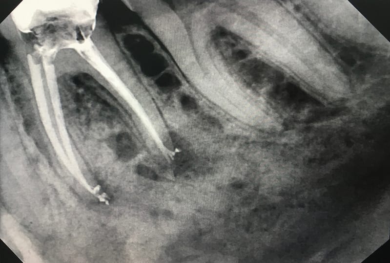 Root Canal Photo